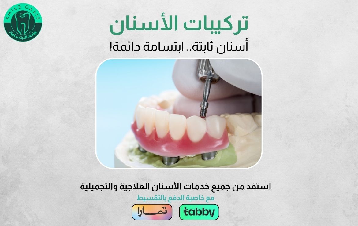عروض تركيبات الأسنان
