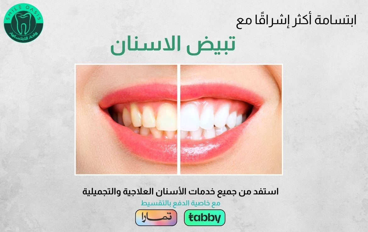 عروض تبييض الأسنان