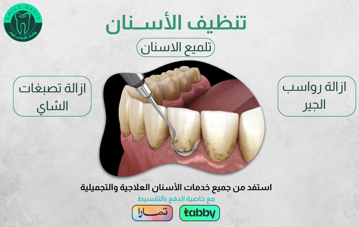 عروض تنظيف الأسنان