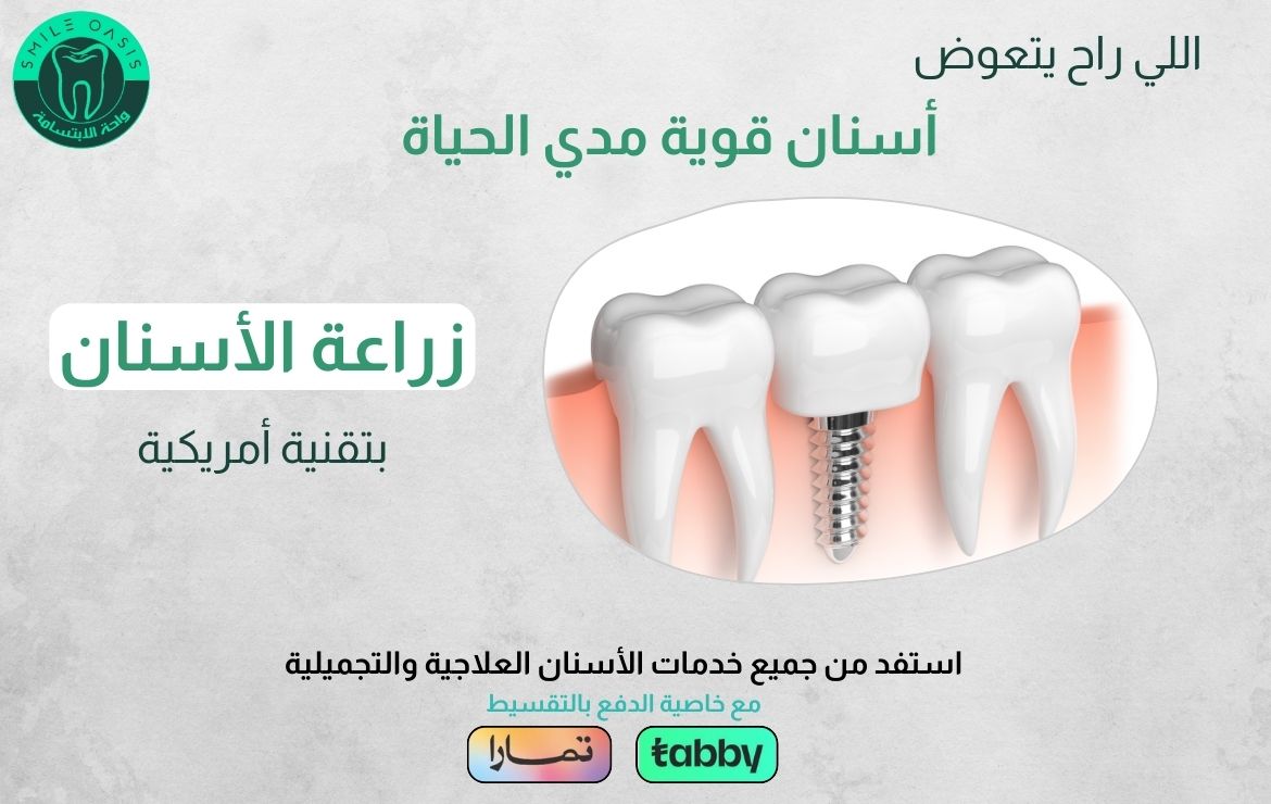 عروض زراعة الأسنان